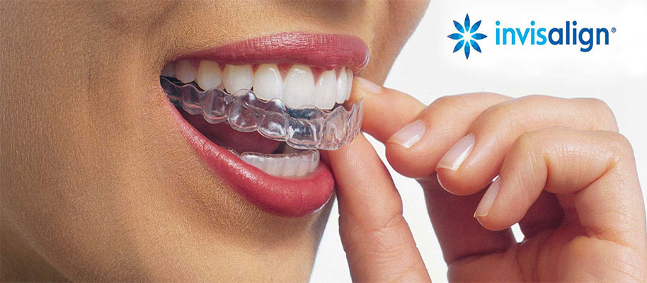 invisalign-mascherina invisalign-mascherina